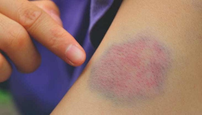 کبودی خارش&zwnj;دار؛ از دلایل تا درمان